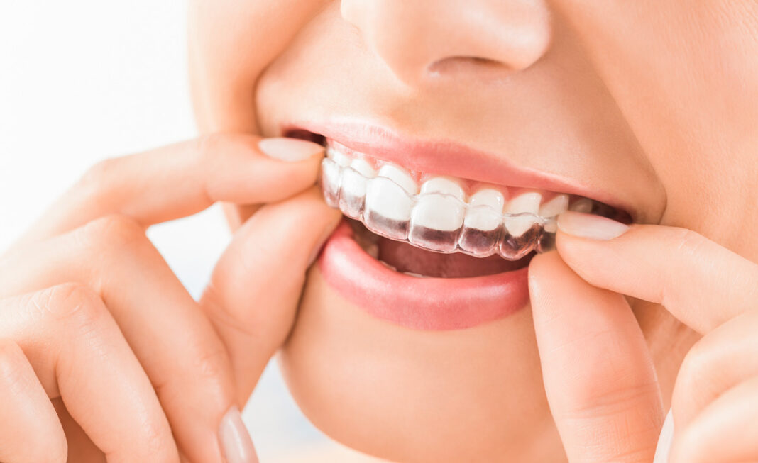 Beautiful smile and white teeth of a young woman. Aligner sind eine nahezu unsichtbare und komfortable Methode zur Korrektur von Zahnfehlstellungen. Foto: istock